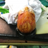 تصاویر دو جراحی دشوار و نادر مغز و اعصاب توسط دکتر نادر نوبری در سبزوار